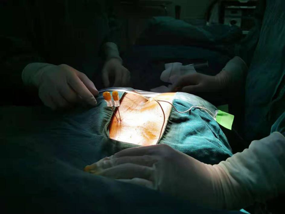 膀胱起搏器植入图片图片
